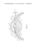 SYSTEMS AND METHODS FOR DELIVERING AN OCULAR IMPLANT TO THE SUPRACHOROIDAL     SPACE WITHIN AN EYE diagram and image