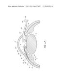 SYSTEMS AND METHODS FOR DELIVERING AN OCULAR IMPLANT TO THE SUPRACHOROIDAL     SPACE WITHIN AN EYE diagram and image