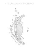 SYSTEMS AND METHODS FOR DELIVERING AN OCULAR IMPLANT TO THE SUPRACHOROIDAL     SPACE WITHIN AN EYE diagram and image