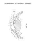 SYSTEMS AND METHODS FOR DELIVERING AN OCULAR IMPLANT TO THE SUPRACHOROIDAL     SPACE WITHIN AN EYE diagram and image