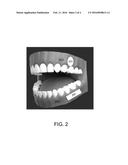ORAL ANESTHESIA APPLICATION diagram and image