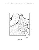 NEURAL STIMULATION DEVICES AND SYSTEMS FOR TREATMENT OF CHRONIC     INFLAMMATION diagram and image