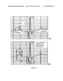 ELECTROCARDIOGRAPHY TRIGGERED TRANSCRANIAL MAGNETIC STIMULATION SYSTEMS     AND METHODS OF USING THE SAME diagram and image