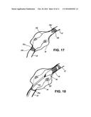 BLOOD FLOW DISRUPTION DEVICES AND METHODS FOR THE TREATMENT OF VASCULAR     DEFECTS diagram and image