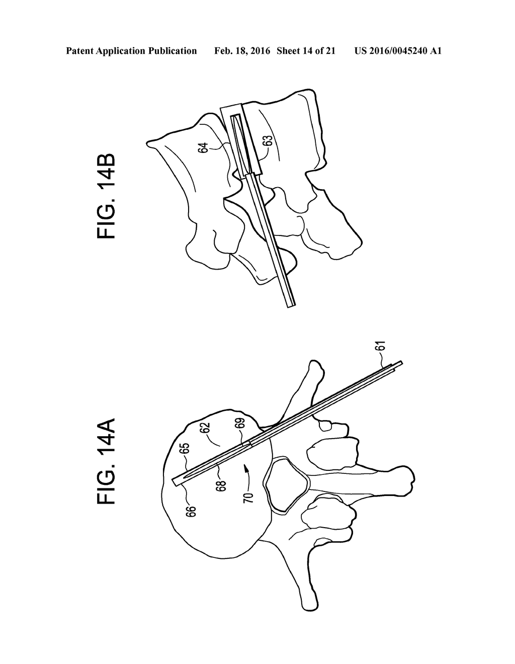 Balloon With Shape Control For Spinal Procedures - diagram, schematic, and image 15