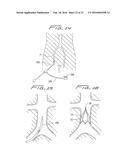 VEIN FILTER diagram and image