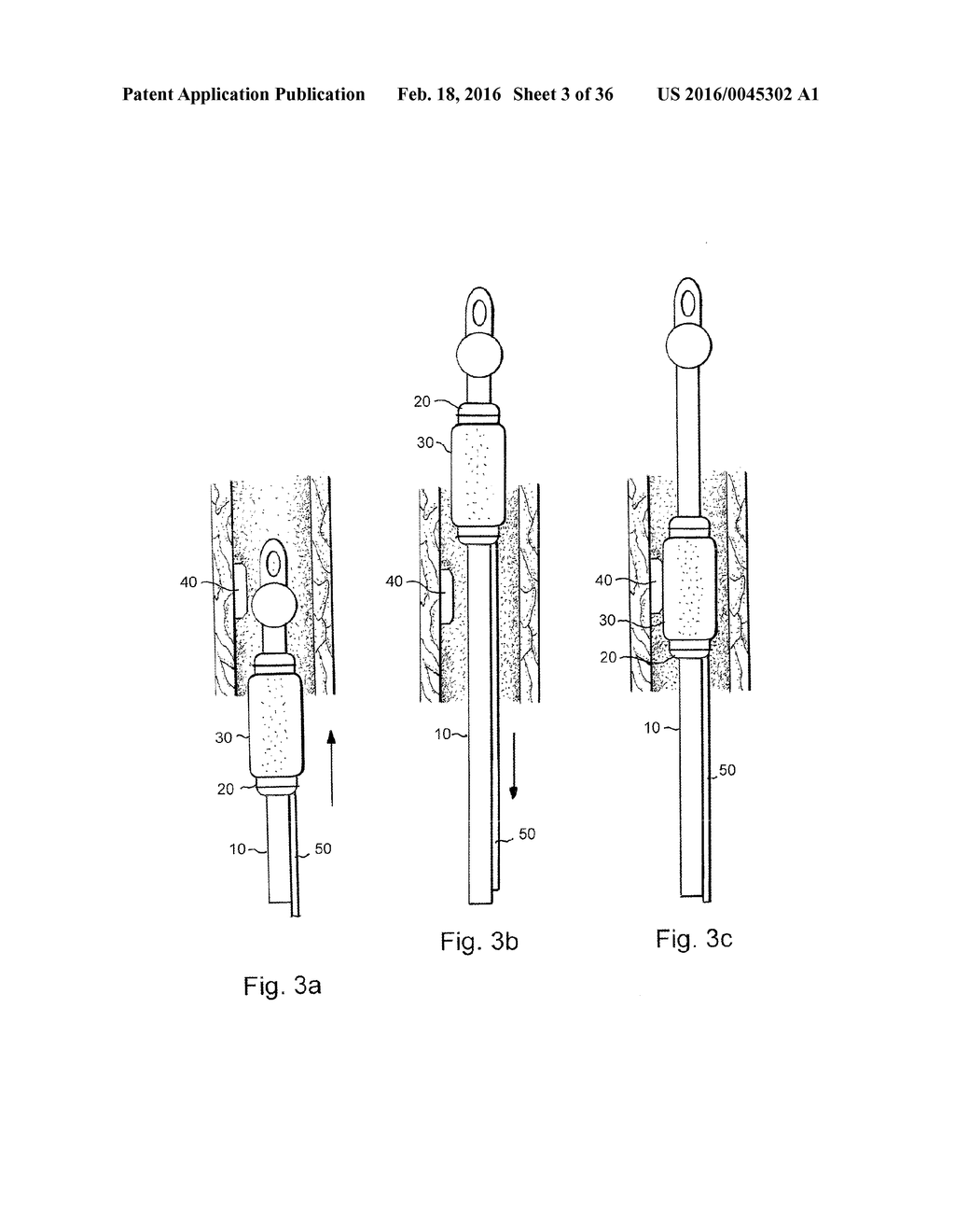 METHOD AND APPARATUS FOR TREATING URETHRAL STRICTURE - diagram, schematic, and image 04