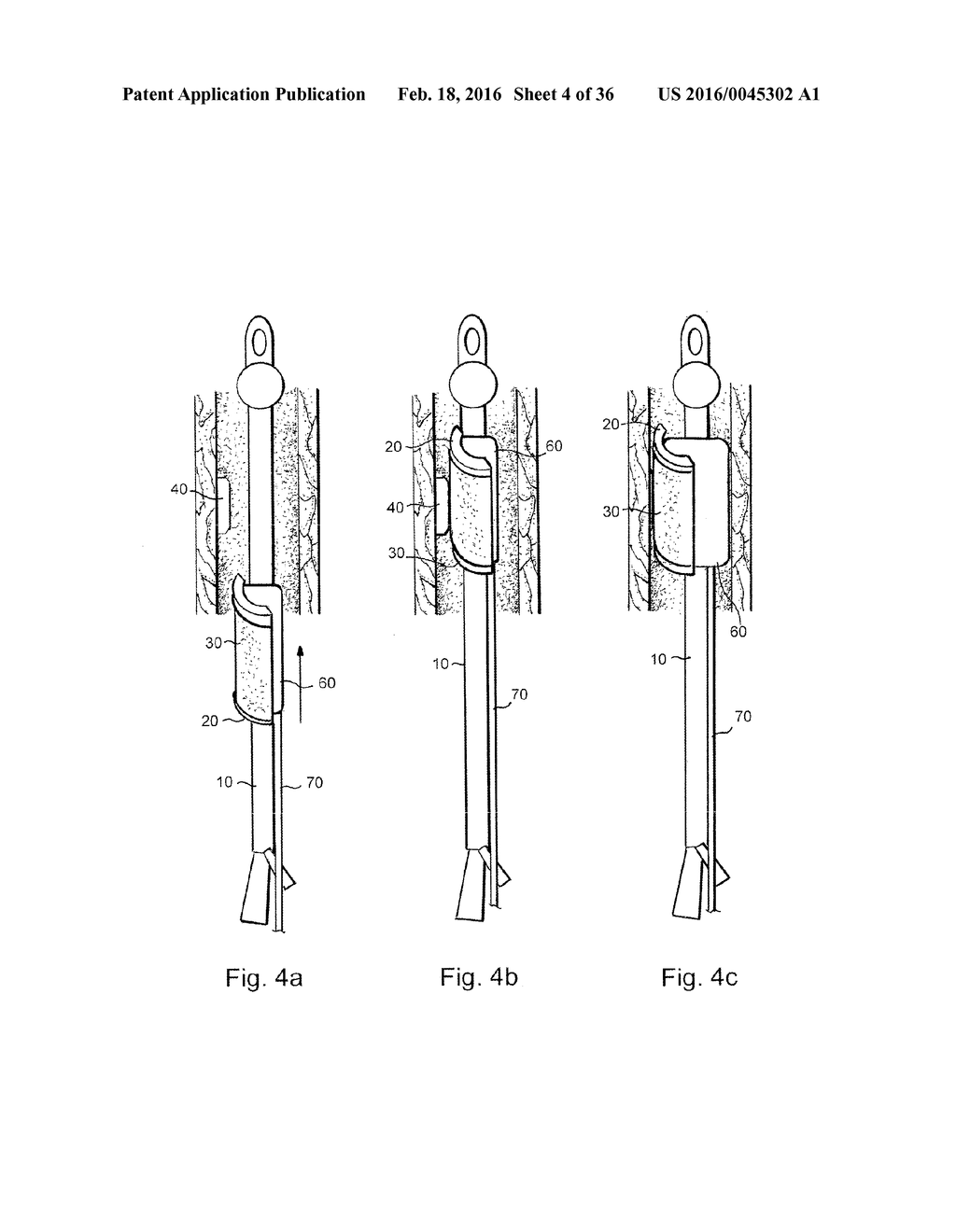 METHOD AND APPARATUS FOR TREATING URETHRAL STRICTURE - diagram, schematic, and image 05