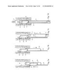 METHOD AND APPARATUS FOR TREATING URETHRAL STRICTURE diagram and image