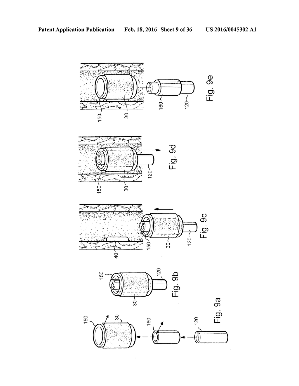 METHOD AND APPARATUS FOR TREATING URETHRAL STRICTURE - diagram, schematic, and image 10