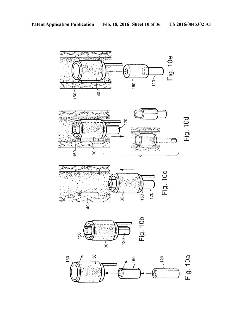 METHOD AND APPARATUS FOR TREATING URETHRAL STRICTURE - diagram, schematic, and image 11