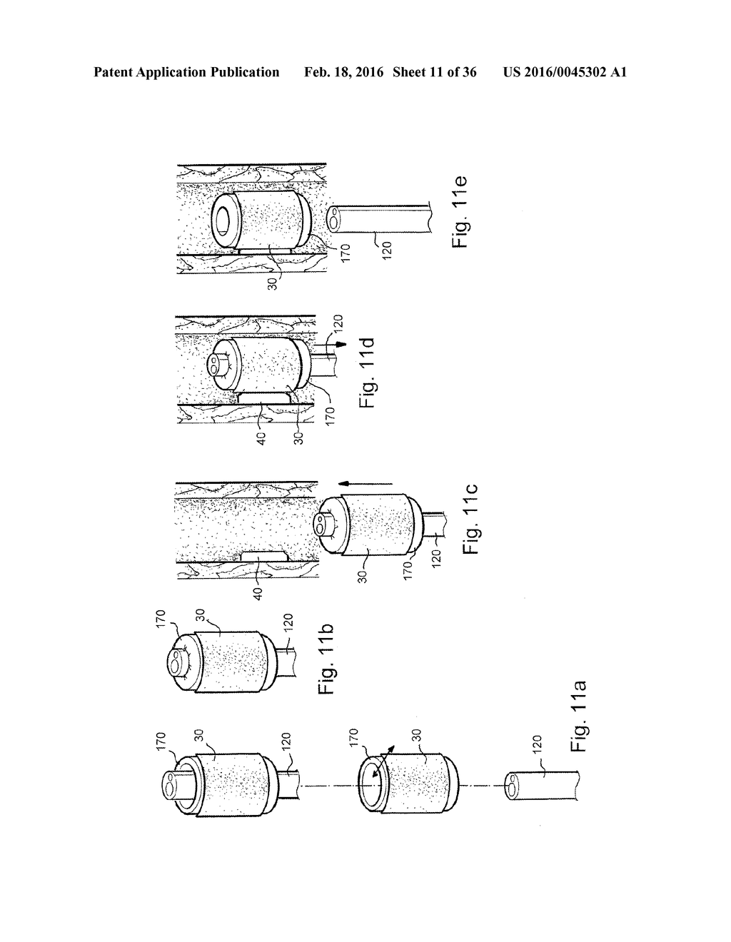 METHOD AND APPARATUS FOR TREATING URETHRAL STRICTURE - diagram, schematic, and image 12