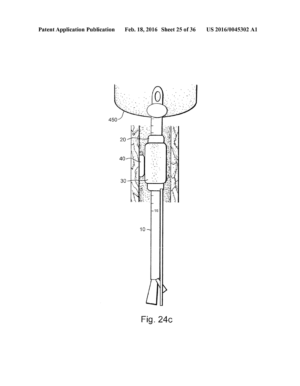 METHOD AND APPARATUS FOR TREATING URETHRAL STRICTURE - diagram, schematic, and image 26