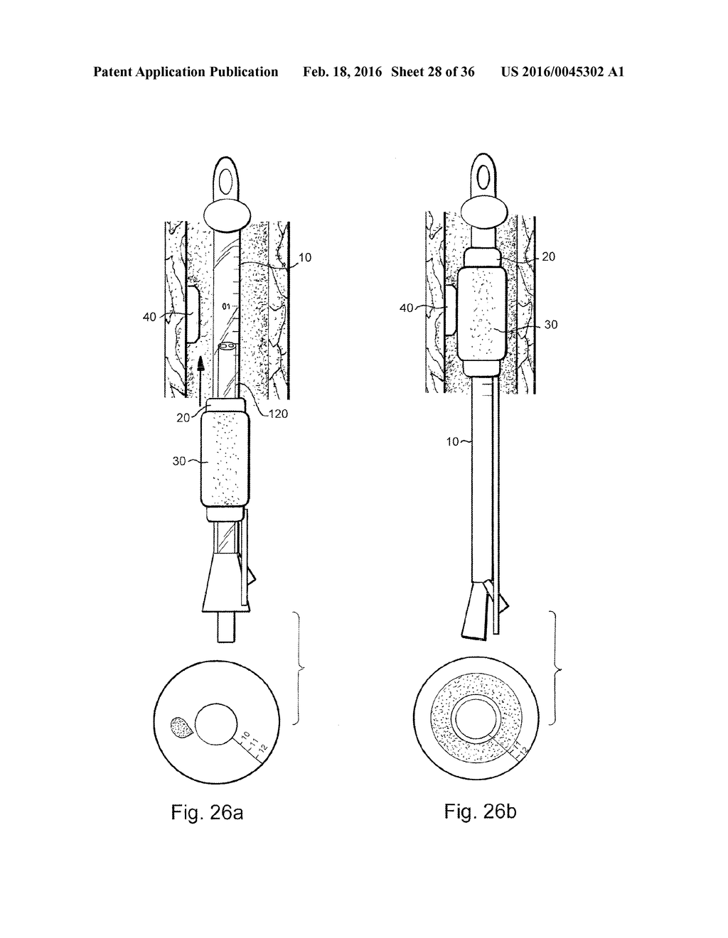 METHOD AND APPARATUS FOR TREATING URETHRAL STRICTURE - diagram, schematic, and image 29