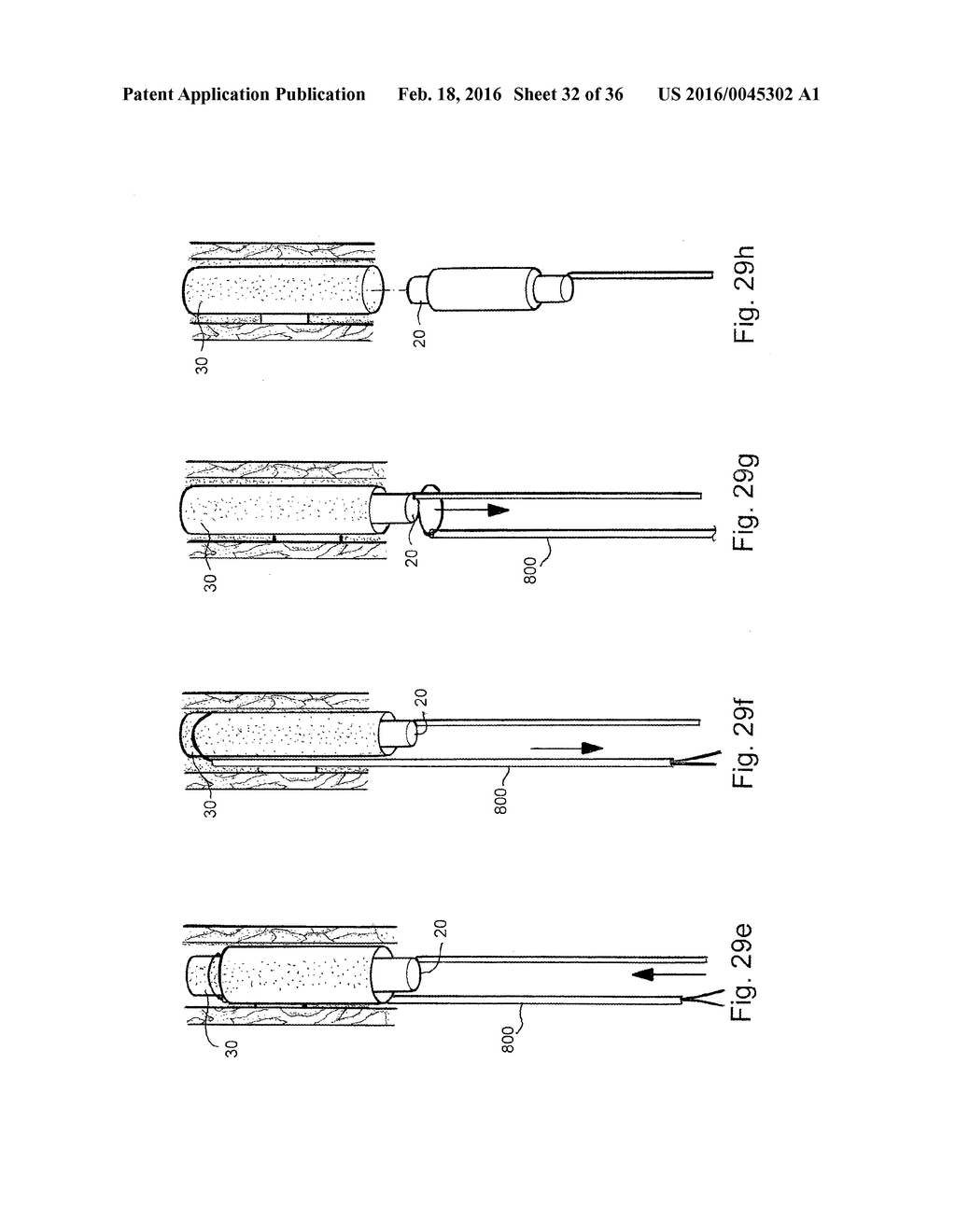 METHOD AND APPARATUS FOR TREATING URETHRAL STRICTURE - diagram, schematic, and image 33