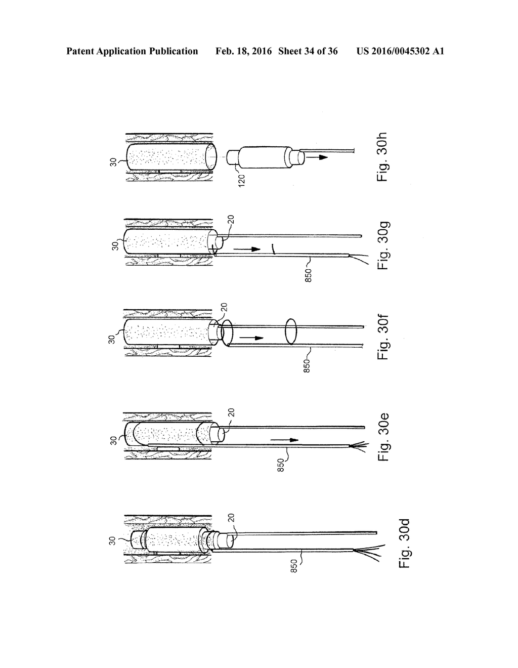 METHOD AND APPARATUS FOR TREATING URETHRAL STRICTURE - diagram, schematic, and image 35