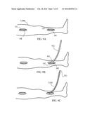 EXTERNAL SUPPORT FOR ELONGATED BODILY VESSELS diagram and image