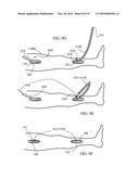 EXTERNAL SUPPORT FOR ELONGATED BODILY VESSELS diagram and image