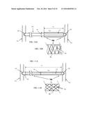 EXTERNAL SUPPORT FOR ELONGATED BODILY VESSELS diagram and image