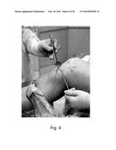 Apparatus and Method for Clamping and Trimming the Bone Tendon Portion of     a Graft to a Desired Size diagram and image