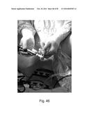 Apparatus and Method for Clamping and Trimming the Bone Tendon Portion of     a Graft to a Desired Size diagram and image