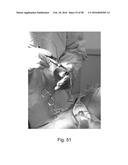 Apparatus and Method for Clamping and Trimming the Bone Tendon Portion of     a Graft to a Desired Size diagram and image