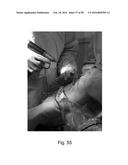 Apparatus and Method for Clamping and Trimming the Bone Tendon Portion of     a Graft to a Desired Size diagram and image