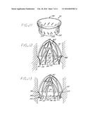 Heart Valve Annulus Device and Method of Using Same diagram and image