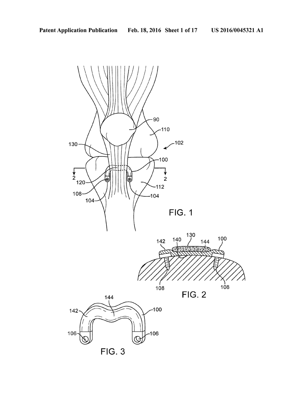 Spacers for Redistributing Forces for the Patella - diagram, schematic, and image 02