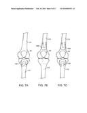 Spacers for Redistributing Forces for the Patella diagram and image