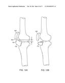 Spacers for Redistributing Forces for the Patella diagram and image