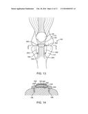 Spacers for Redistributing Forces for the Patella diagram and image