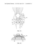 Spacers for Redistributing Forces for the Patella diagram and image
