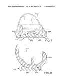 TIBIAL BEARING COMPONENT FOR A KNEE PROSTHESIS WITH IMPROVED ARTICULAR     CHARACTERISTICS diagram and image