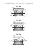 IMPLANT CONTAINING RODS diagram and image