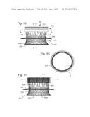 IMPLANT CONTAINING RODS diagram and image