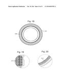 IMPLANT CONTAINING RODS diagram and image