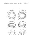 IMPLANT CONTAINING RODS diagram and image