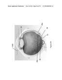 IMPLANTS WITH CONTROLLED DRUG DELIVERY FEATURES AND METHODS OF USING SAME diagram and image