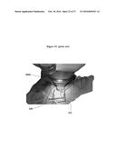 COMBINED LASER AND PHACOEMULSIFICATION SYSTEM FOR EYE SURGERY diagram and image