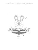 DEPLOYING FASTENERS diagram and image