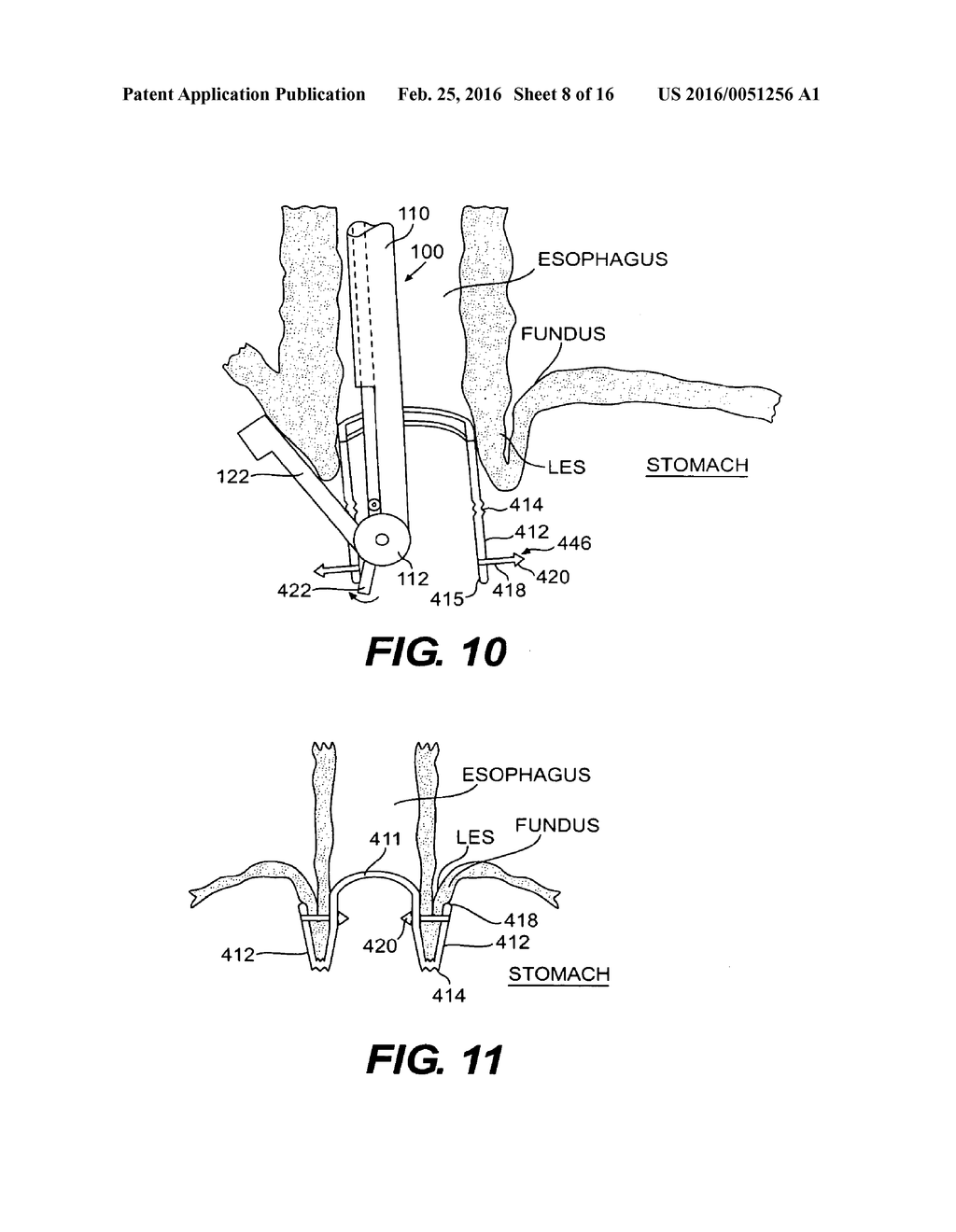 METHODS AND DEVICES FOR FOLDING AND SECURING TISSUE - diagram, schematic, and image 09