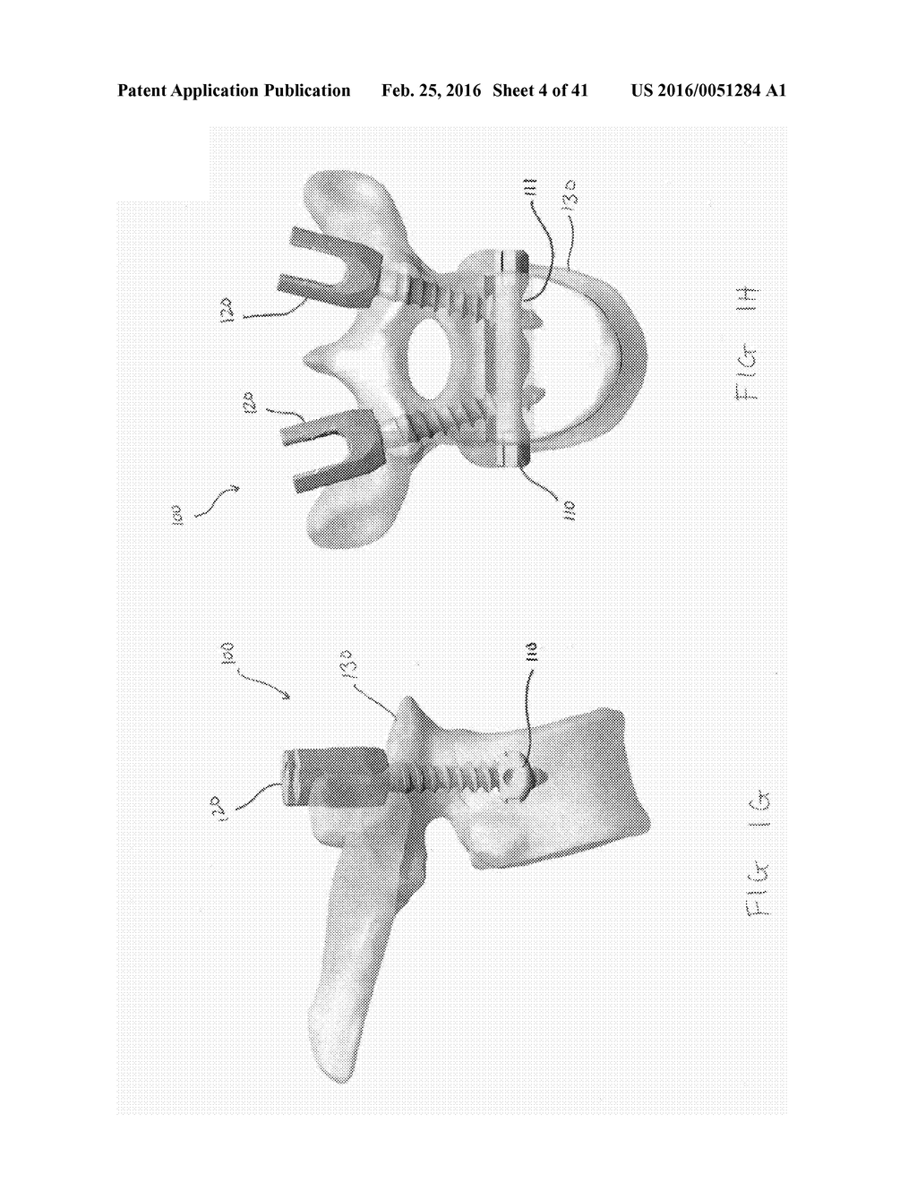 CIRCUMFERENTIAL VERTEBRAL COLUMN FIXATION SYSTEM - diagram, schematic, and image 05