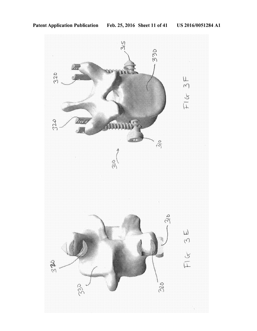 CIRCUMFERENTIAL VERTEBRAL COLUMN FIXATION SYSTEM - diagram, schematic, and image 12