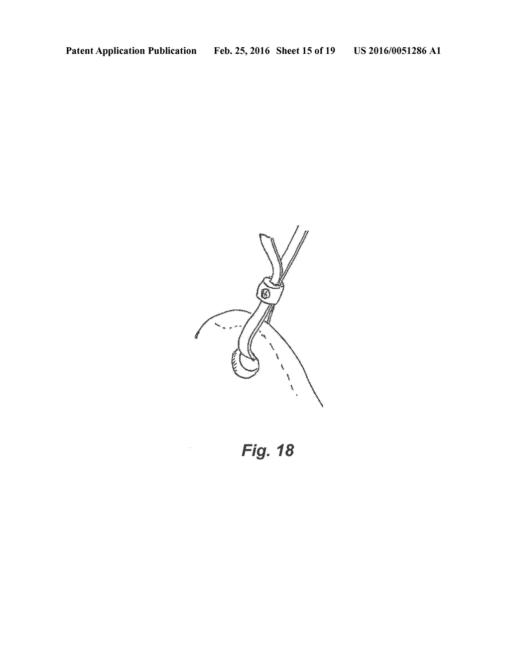 DEVICE AND METHOD FOR TREATMENT OF SPINAL DEFORMITY - diagram, schematic, and image 16