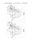 COMPOSITE MATERIAL SPINAL IMPLANT diagram and image