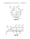 APPARATUS AND METHOD FOR TREATING A NEUROMUSCULAR DEFECT diagram and image