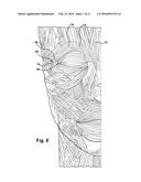 APPARATUS AND METHOD FOR TREATING A NEUROMUSCULAR DEFECT diagram and image