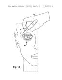 APPARATUS AND METHOD FOR TREATING A NEUROMUSCULAR DEFECT diagram and image