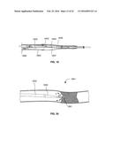 DEVICE AND METHODS FOR CROSSING OCCLUSIONS diagram and image